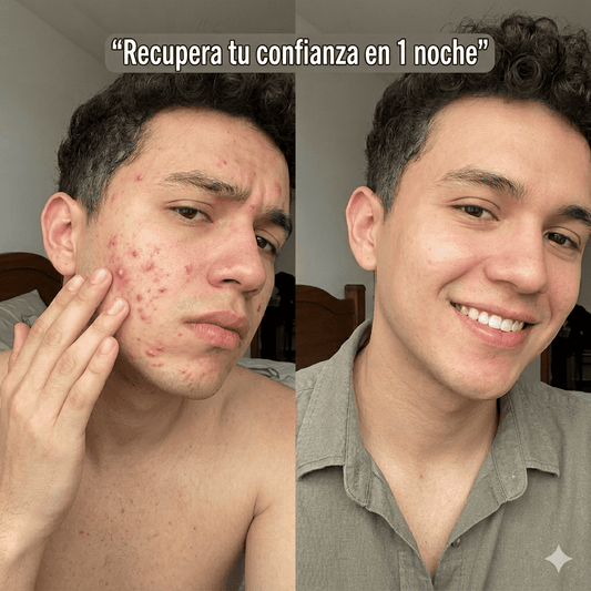 🔥 Desinflama ese grano en una sola noche y recupera tu confianza 😱